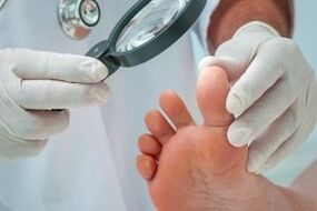 Liječenje plantarnih bradavica