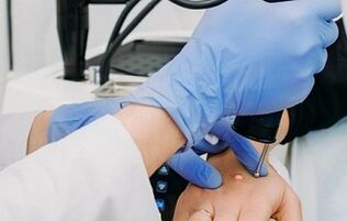 načini uklanjanja bradavica