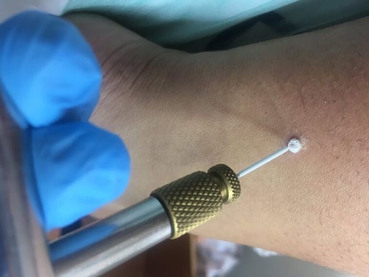 načini uklanjanja bradavica