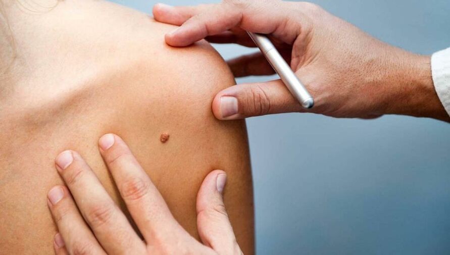 Dermatolog pregledava pacijenta s papilomom