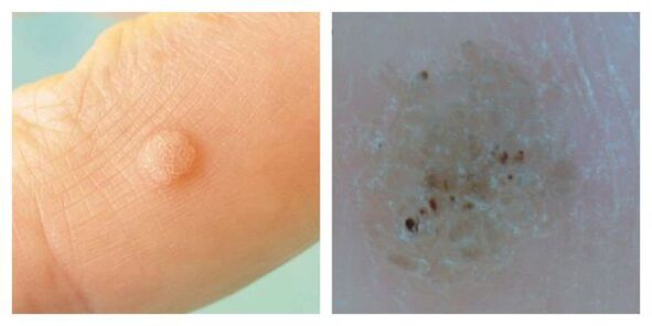 Obična bradavica tijekom ispitivanja i dermatoskopije