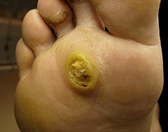 Subanarni papilomi